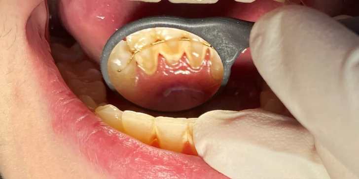 Okouzlete zářivým úsměvem: dentální hygiena ve Stodůlkách pro děti i dospělé, vč. možnosti bělení