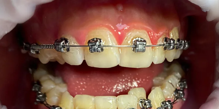 Okouzlete zářivým úsměvem: dentální hygiena ve Stodůlkách pro děti i dospělé, vč. možnosti bělení
