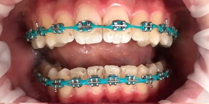 Okouzlete zářivým úsměvem: dentální hygiena ve Stodůlkách pro děti i dospělé, vč. možnosti bělení