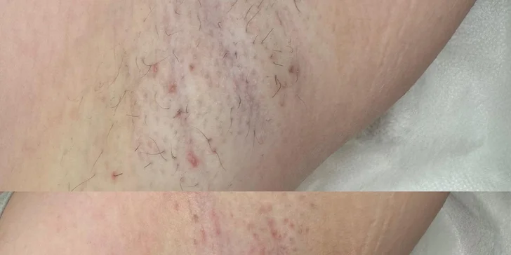 Depilace cukrovou pastou či voskem vybrané partie