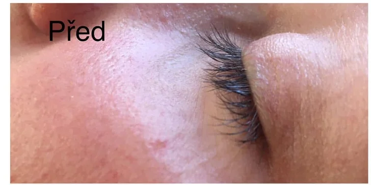 Kosmetické ošetření dle výběru: kompletní péče, lash lifting, radiofrekvence i kyselina hyaluronová