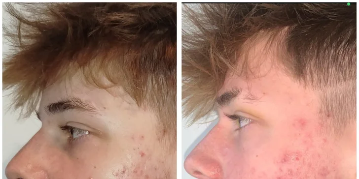 Opečujte svou pleť: chemický peeling s kyselinou hyaluronovou, 30 minut