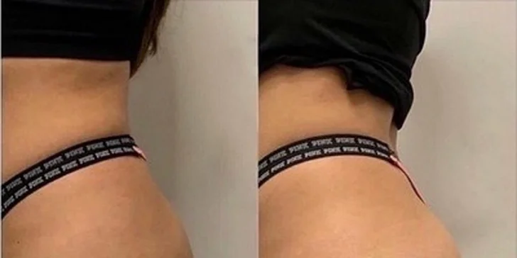 EMS trénink zaměřený na 1 nebo 2 partie i kombinace s maderoterapií