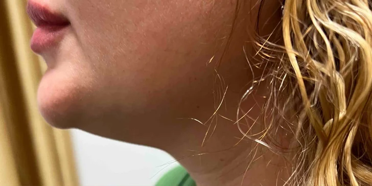 Omlazení a zpevnění pleti: Thermage či Hifu lifting obličeje, 30–⁠⁠⁠⁠⁠⁠60 minut