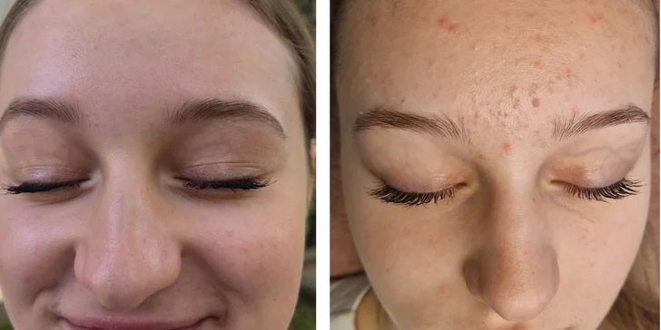 Kosmetika v Karlíně: základní péče, mezoterapie i hloubkové čištění s exozomy