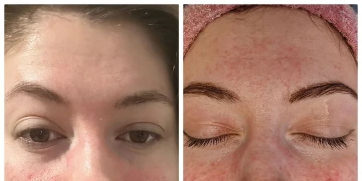 Kosmetika v Karlíně: základní péče, mezoterapie i hloubkové čištění s exozomy