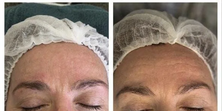 Kosmetika v Karlíně: základní péče, mezoterapie i hloubkové čištění s exozomy