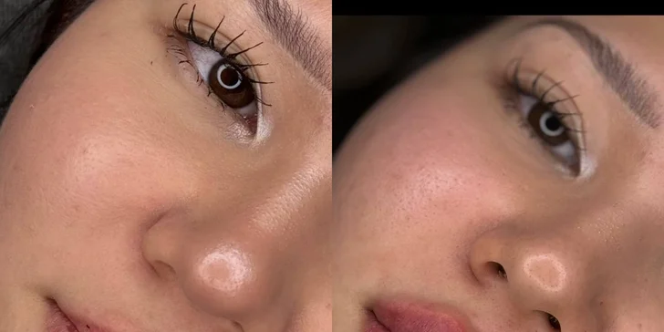 Omlazující výplně: aplikace botulotoxinu, kyseliny hyaluronové a polymlečné kyseliny