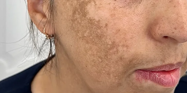 Omlazení pleti: mikrojehličkování s exosomy, biorevitalizace nebo radiofrekvenční lifting