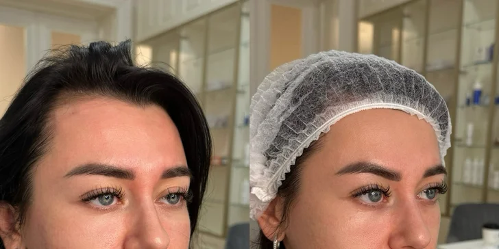 Omlazení pleti: mikrojehličkování s exosomy, biorevitalizace nebo radiofrekvenční lifting