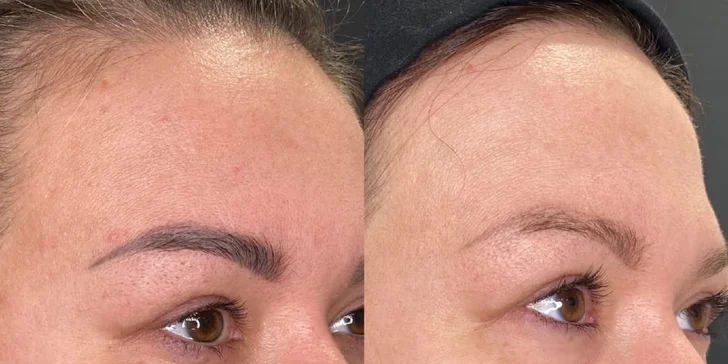 Omlazení pleti: mikrojehličkování s exosomy, biorevitalizace nebo radiofrekvenční lifting