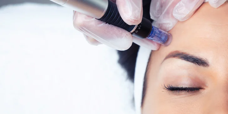 Mezoterapie neboli mikrojehličkování pro omlazení a obnovu pleti