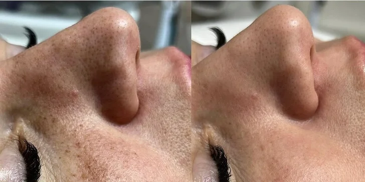 Omlazení pleti: mikrojehličkování s exosomy, biorevitalizace nebo radiofrekvenční lifting