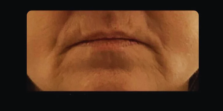 Pleť a úsměv jako filmová hvězda: chemický peeling a regenerační kúra na rty