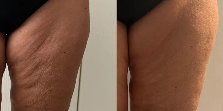 Kompletní ošetření pro tvarování postavy: baňky FUFFU, rollcuping a Vibroslimfit