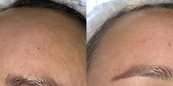 Pleť v nejlepší kondici: anti-age ošetření, bioenzymová terapie či mezoterapie