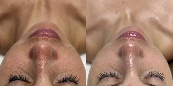 Pleť v nejlepší kondici: anti-age ošetření, bioenzymová terapie či mezoterapie