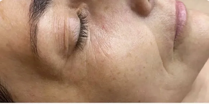 Pleť v nejlepší kondici: anti-age ošetření, bioenzymová terapie či mezoterapie