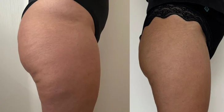 Kompletní ošetření pro tvarování postavy: baňky FUFFU, rollcuping a Vibroslimfit