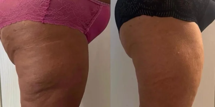 Kompletní ošetření pro tvarování postavy: baňky FUFFU, rollcuping a Vibroslimfit