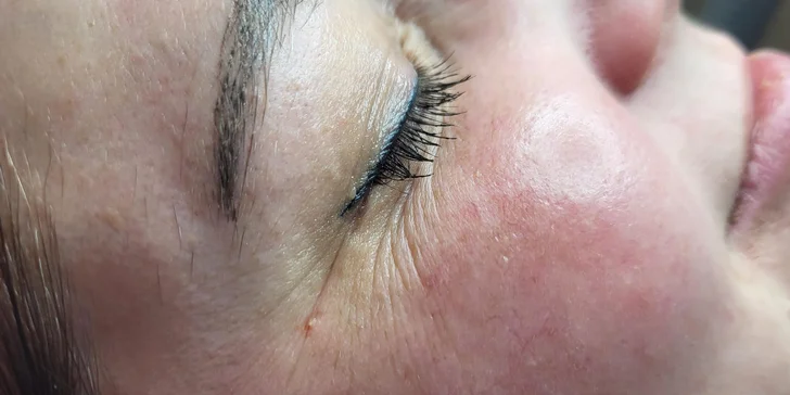 Mikrojehličkování nebo karbonový peeling pro omlazení a obnovu pleti