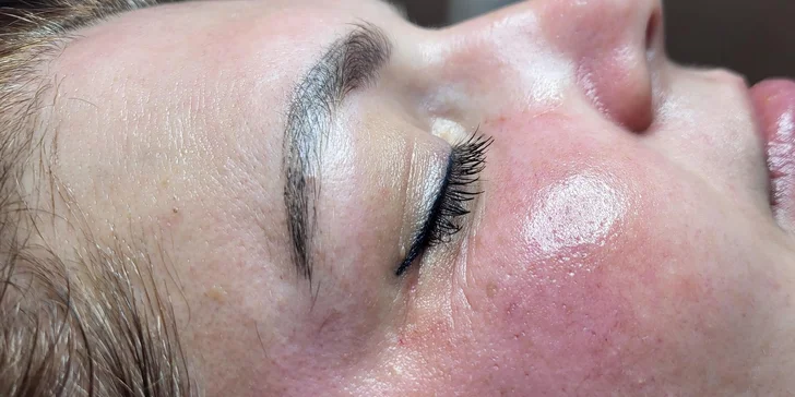 Mikrojehličkování nebo karbonový peeling pro omlazení a obnovu pleti