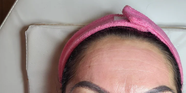 Mikrojehličkování nebo karbonový peeling pro omlazení a obnovu pleti