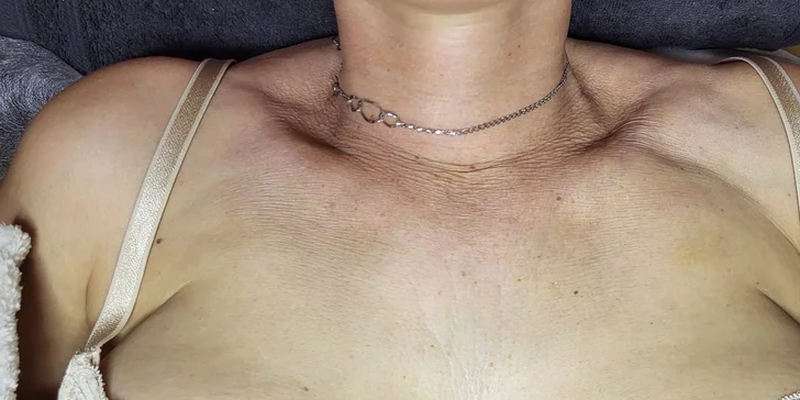 Mikrojehličkování nebo karbonový peeling pro omlazení a obnovu pleti