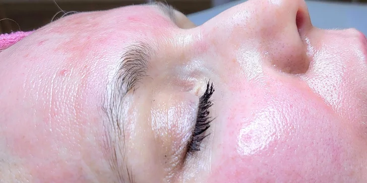 Mikrojehličkování nebo karbonový peeling pro omlazení a obnovu pleti