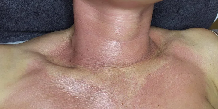 Mikrojehličkování nebo karbonový peeling pro omlazení a obnovu pleti