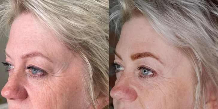 Pro hladkou pleť bez vrásek: ošetření studenou plazmou v luxusním estetickém studiu