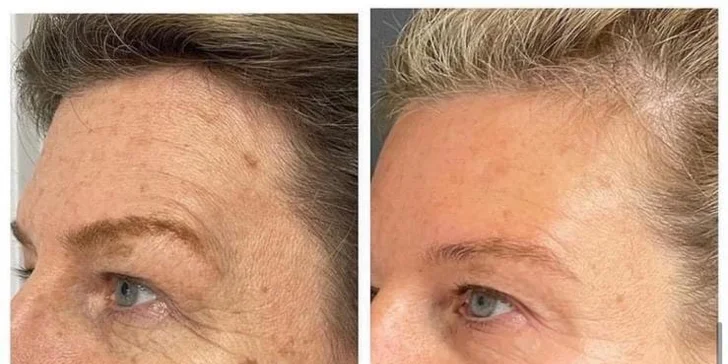 Pro hladkou pleť bez vrásek: ošetření studenou plazmou v luxusním estetickém studiu