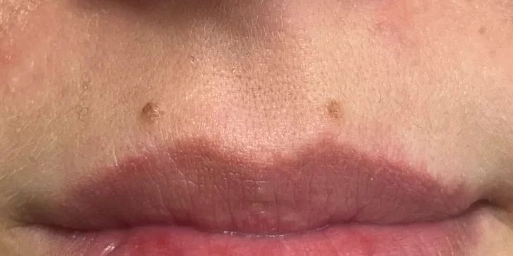 Krásná pleť: chemický peeling s AHA kyselinami v centru Brna