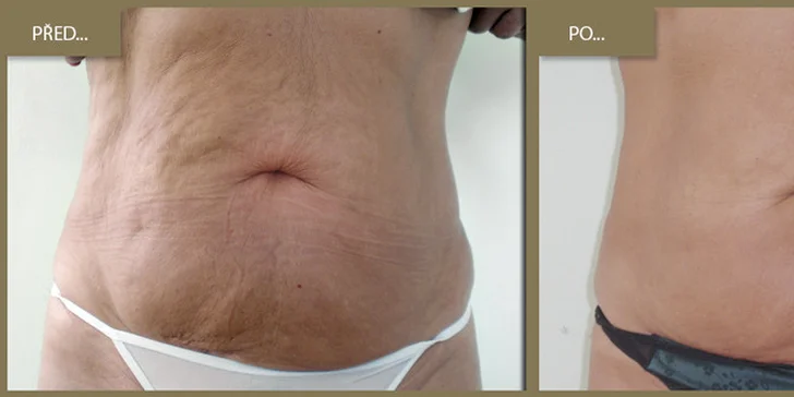 Snížení tukové vrstvy a odstranění celulitidy lypolitickým ultrazvukem - kavitace