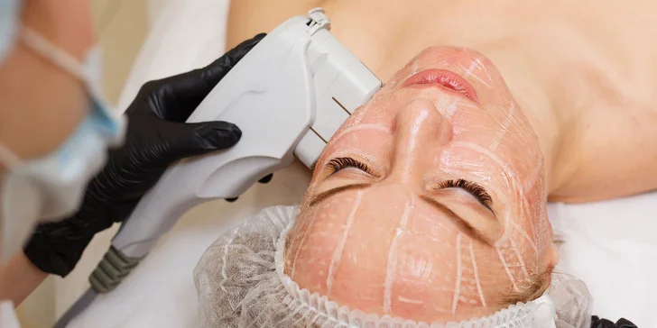 Horný, dolný a celkový facelifting HIFU