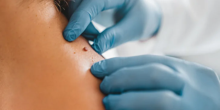 Odstránenie výrastkov, jaziev, vrások či korekcia horných očných viečok