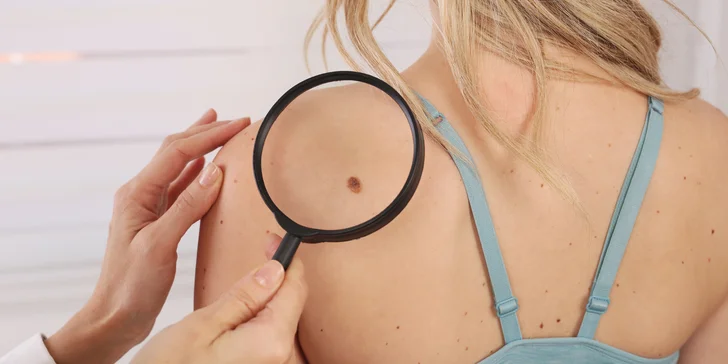 Šetrné a estetické odstránenie znamienok, lipómov, aterómov či gangliómov