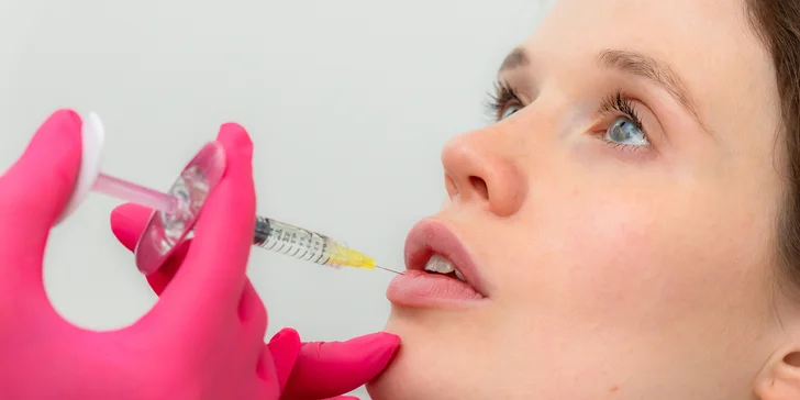 Upravenie, výplň, hydratácia alebo modelácia pier kyselinou hyalurónovou