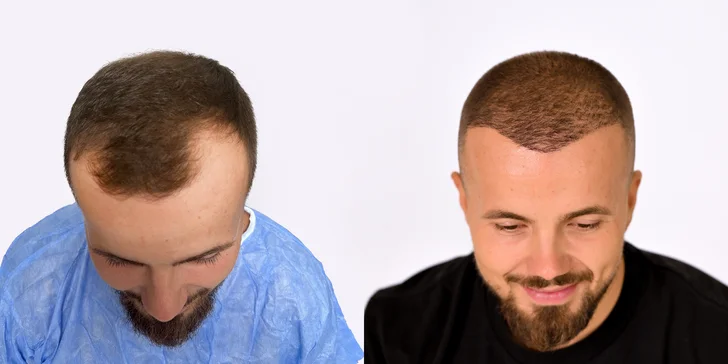Pre a po - viac ako 8 mesiacov