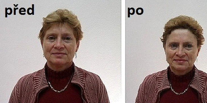 Ošetření tváře a dekoltu plasmovými toky