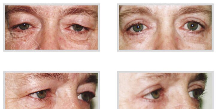 20% sleva na operaci očních víček nebo liposukci