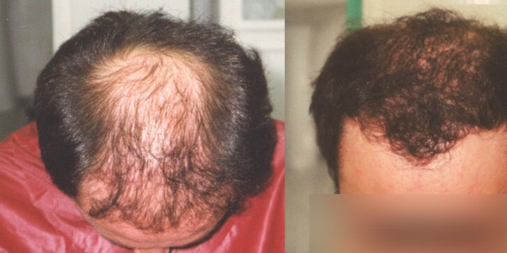 Transplantace vlasů na klinice INTER CLINIC