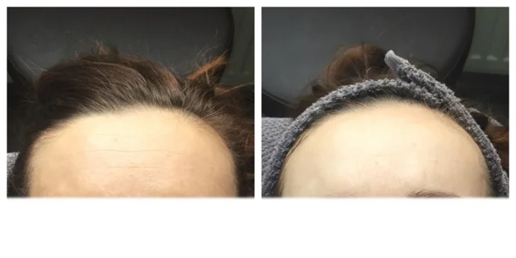 Pred a ihneď po ošetrení zákazníčky v Lumines beauty centre.