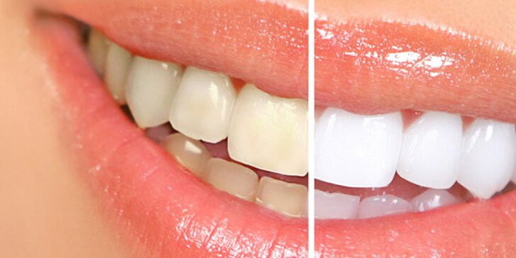 Šetrné laserové bělení zubů v hodnotě 8900 Kč. Zářivě bílý úsměv již po první aplikaci a revoluční metoda Super Boost se slevou 78 %.