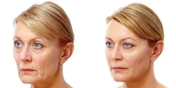 Expresní face lifting - termage a zmenšení podbradku - novinka ve Frýdku-Místku