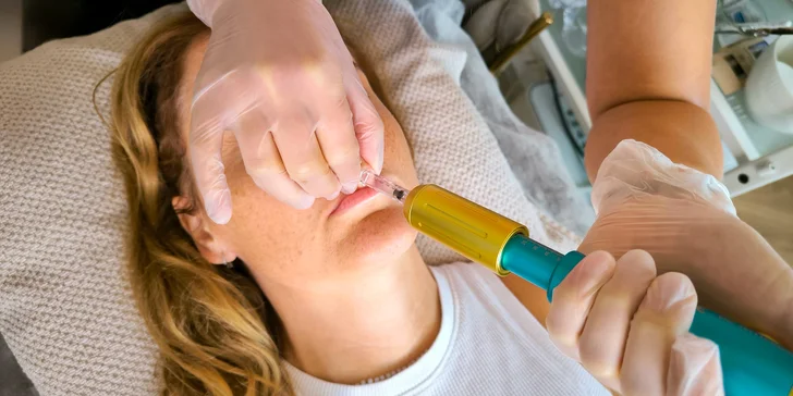 Krásné rty či pleť bez vrásek: jedno nebo dvě ošetření pomocí hyaluron pen