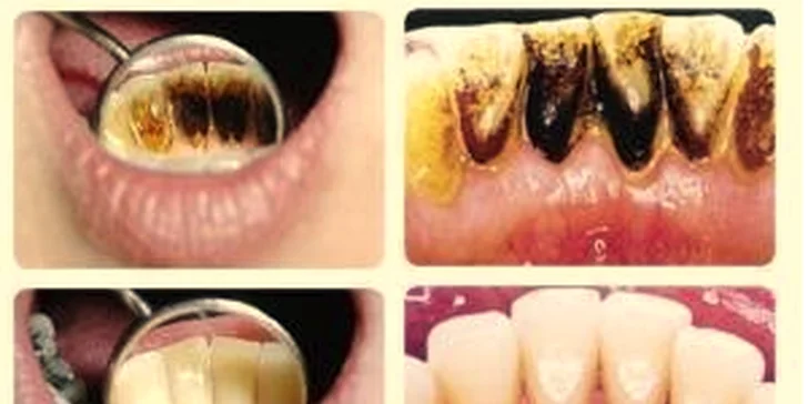 Profesionální dentální hygiena či pískování Air Flow