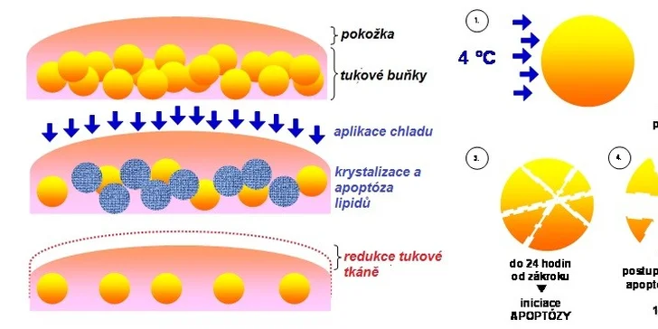 2×40 minut certifikované thermo kryolipolýzy