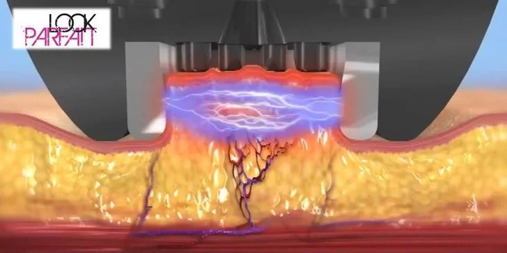 Revoluční liposukce Blue Laser,RF a Vacuum