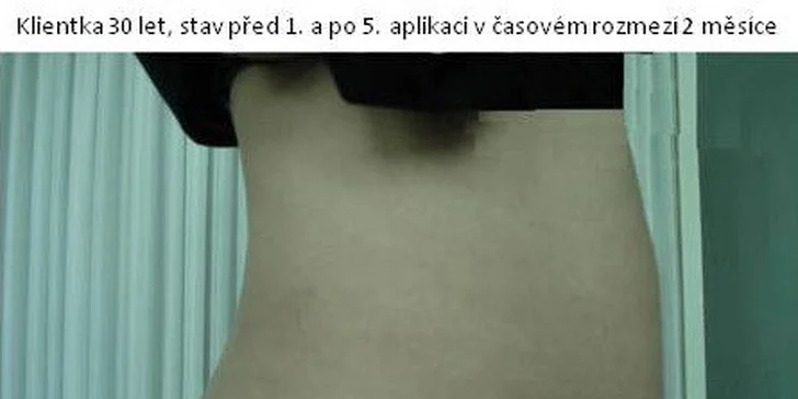 Revoluční liposukce s okamžitým účinkem